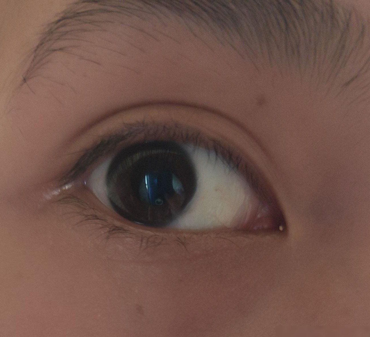 一只眼突然变三眼皮