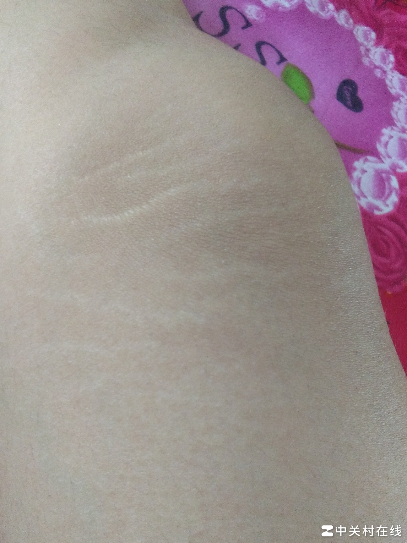 腿上白条怎么去除？