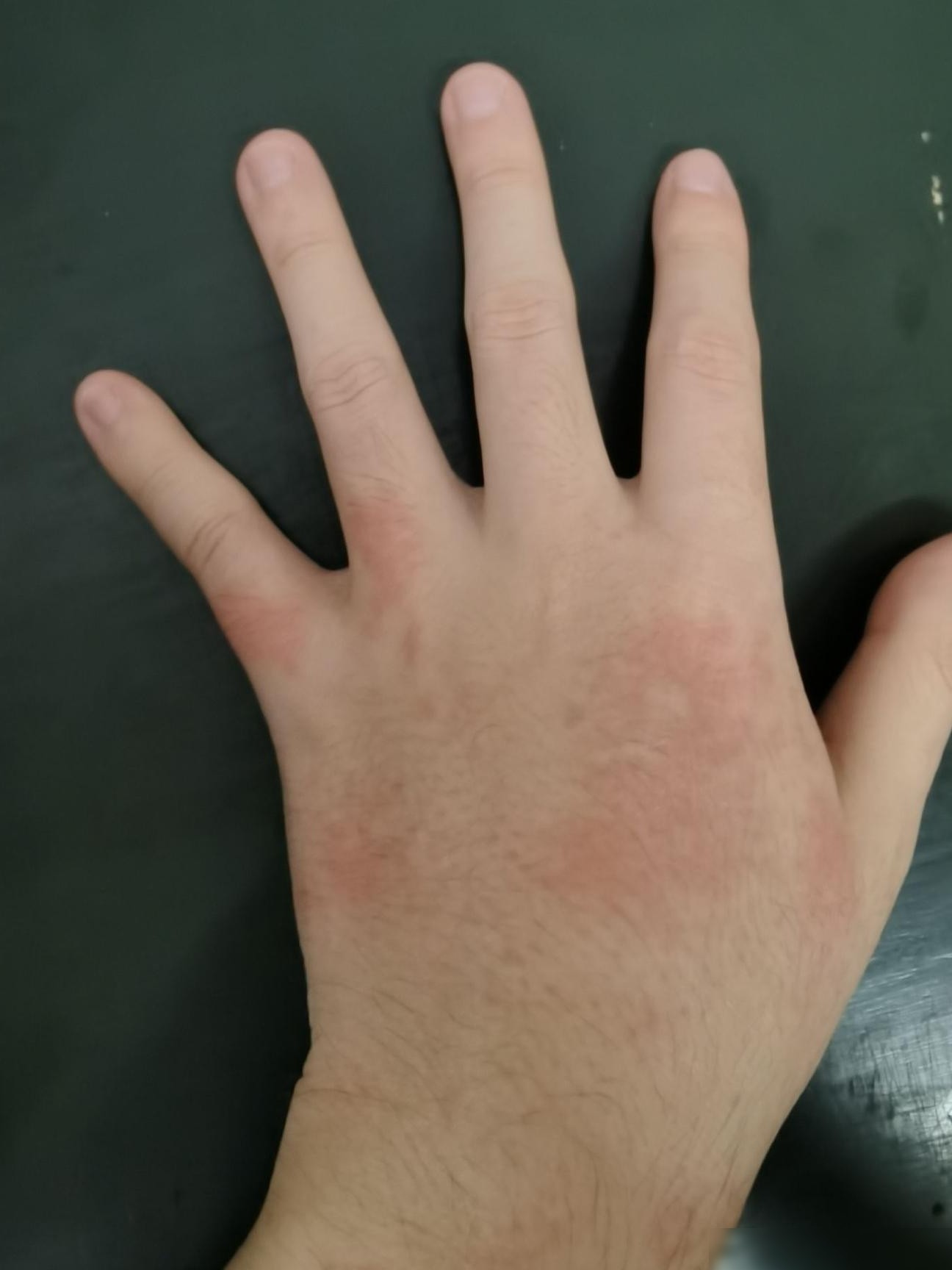 这是什么皮肤病？