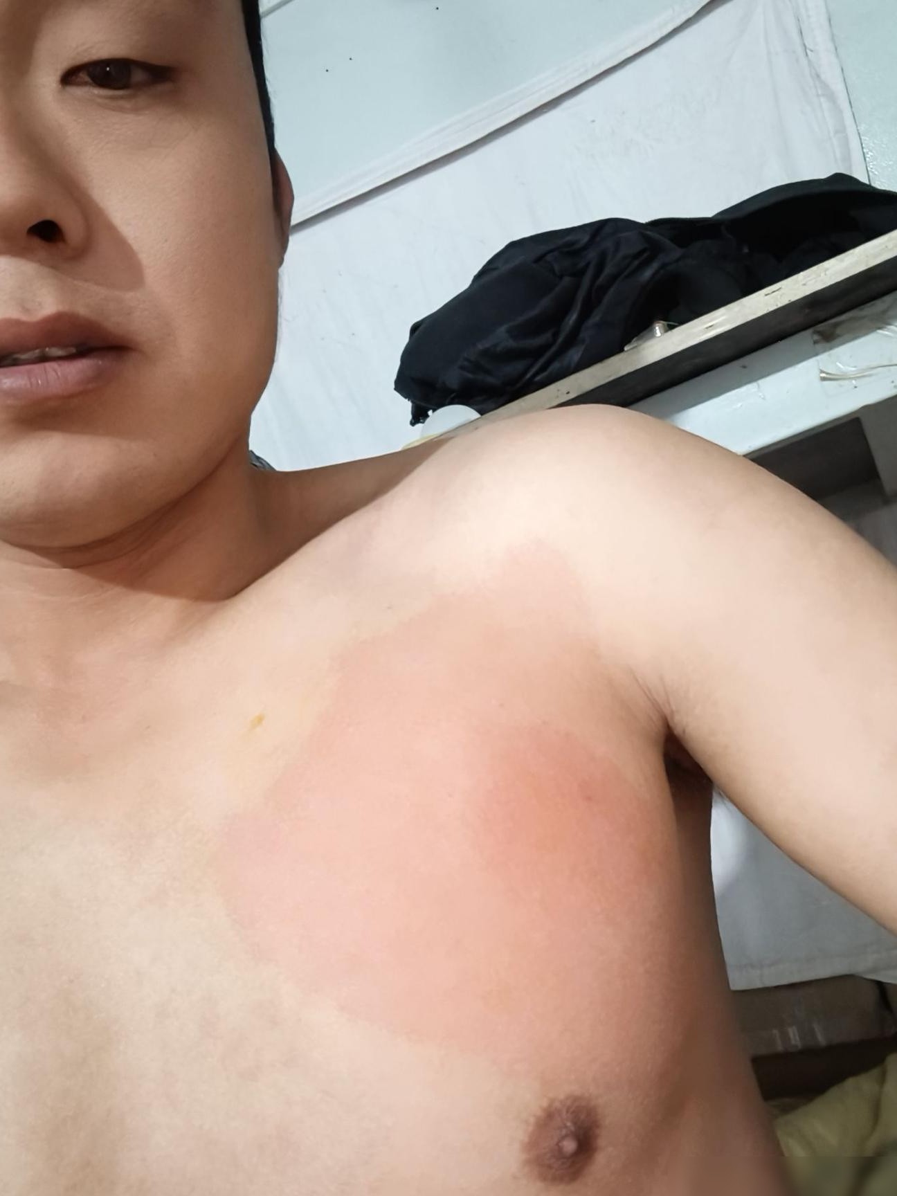 床上被虫咬又痒又痛