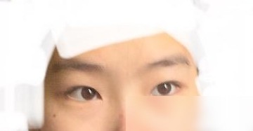 左眼外斜视如何矫正