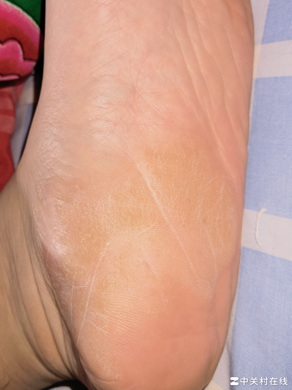 皮肤病常见问题解析