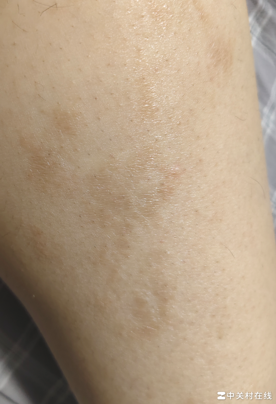 皮肤问题求助，这是什么？