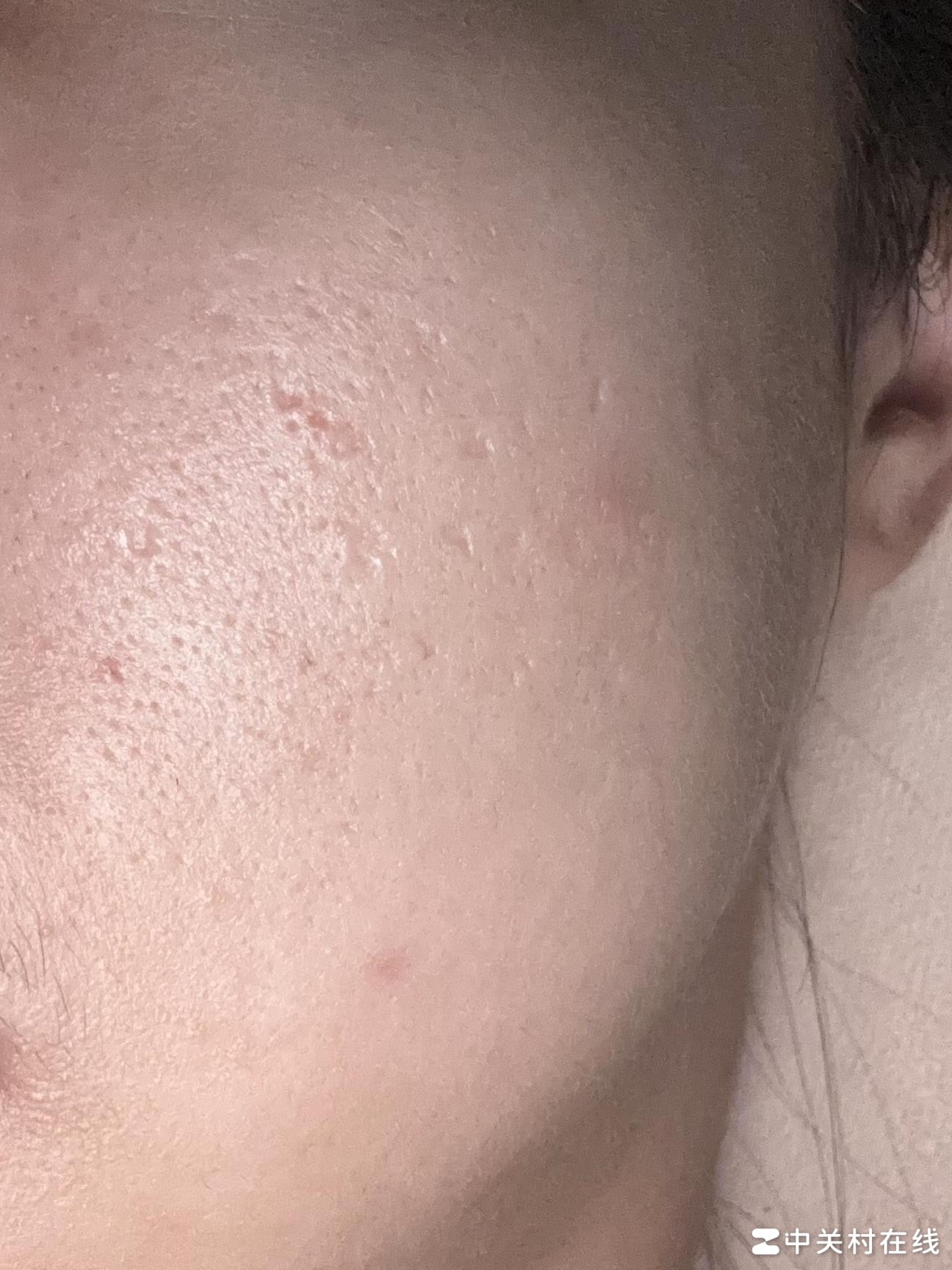 TCA治疗痘坑有效吗？