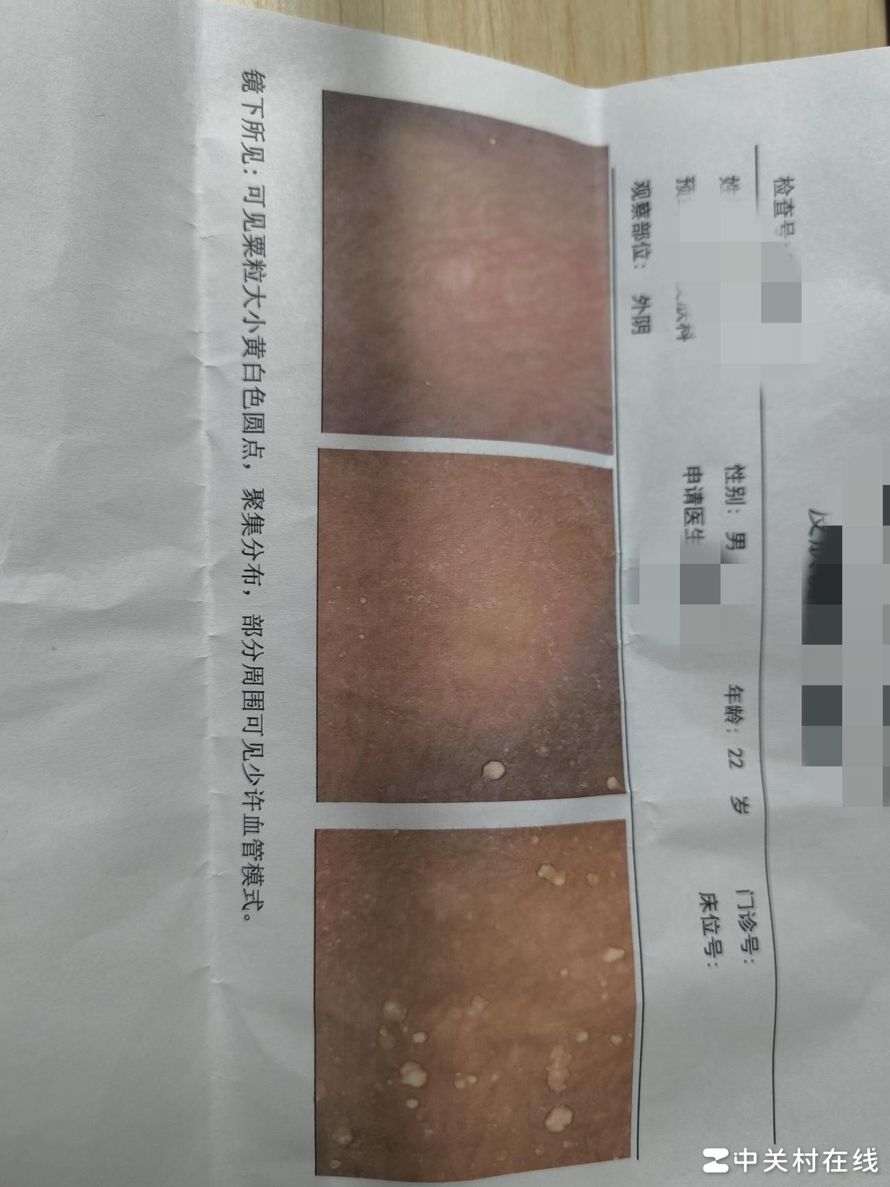 皮脂腺增生是HPV吗？