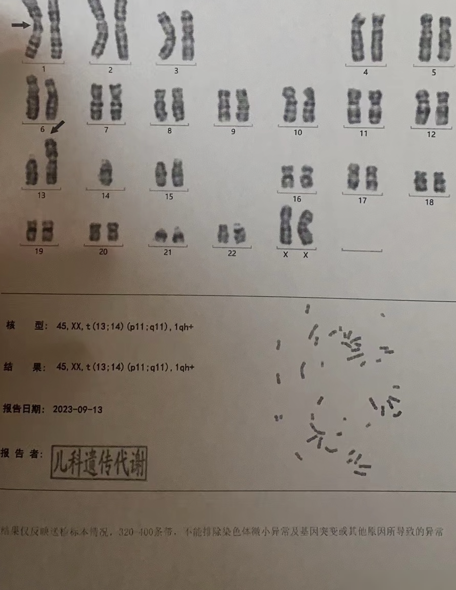 染色体45,XX,t(13;14)解析
