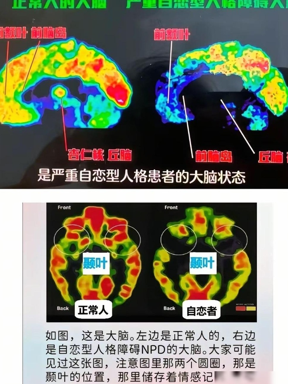 NPD的煤气灯效应揭秘
