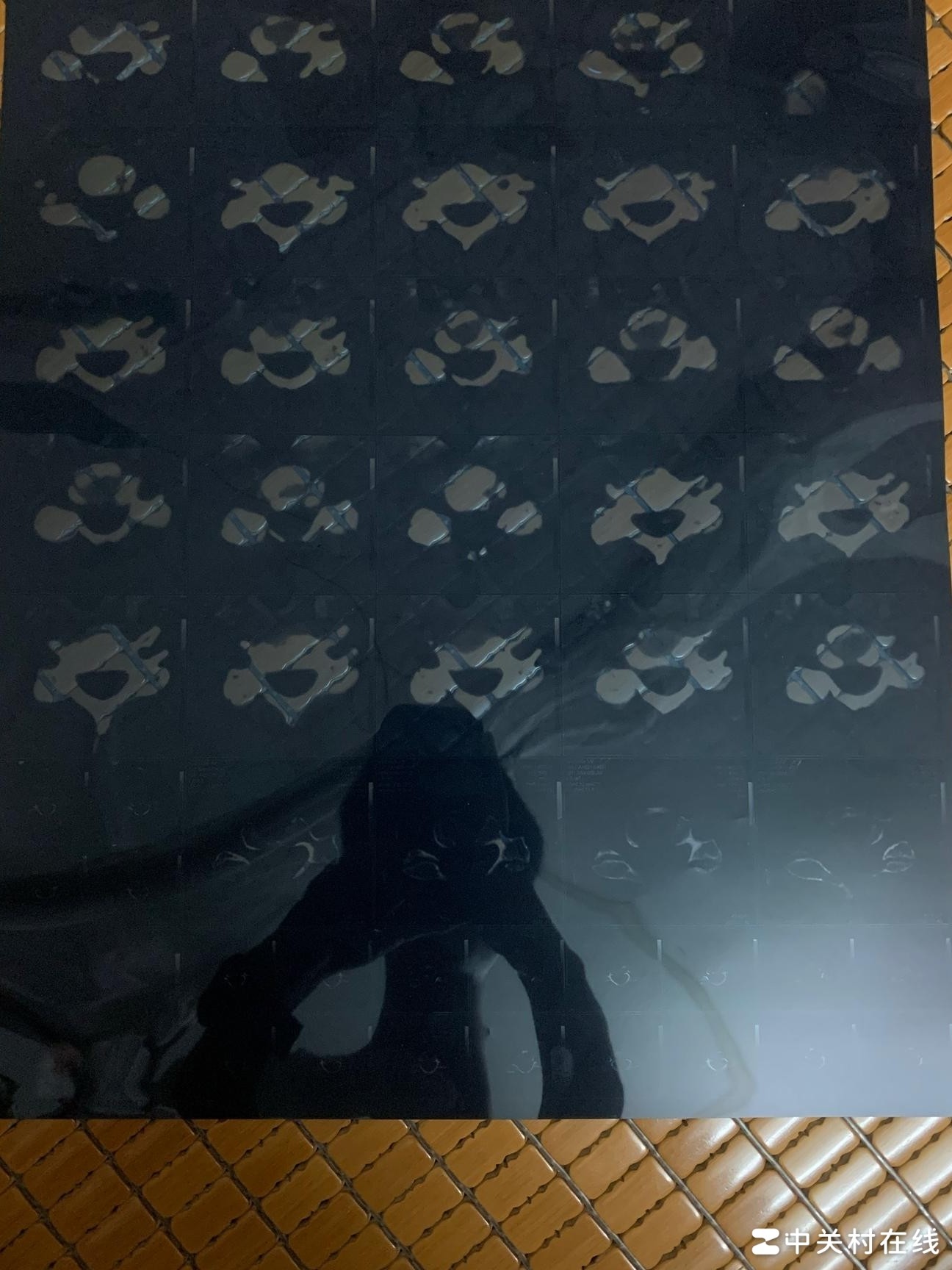 17岁患颈椎病，人生依然精彩