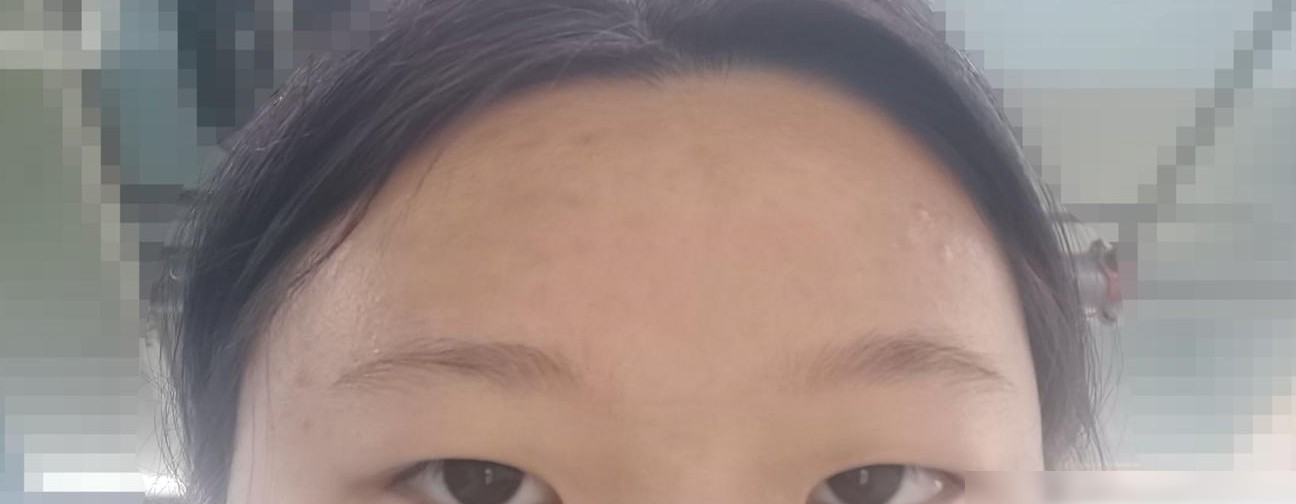 肿泡眼急救小妙招