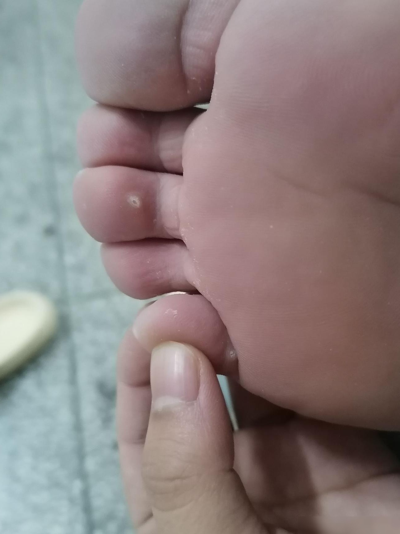脚上白色小疙瘩是啥？