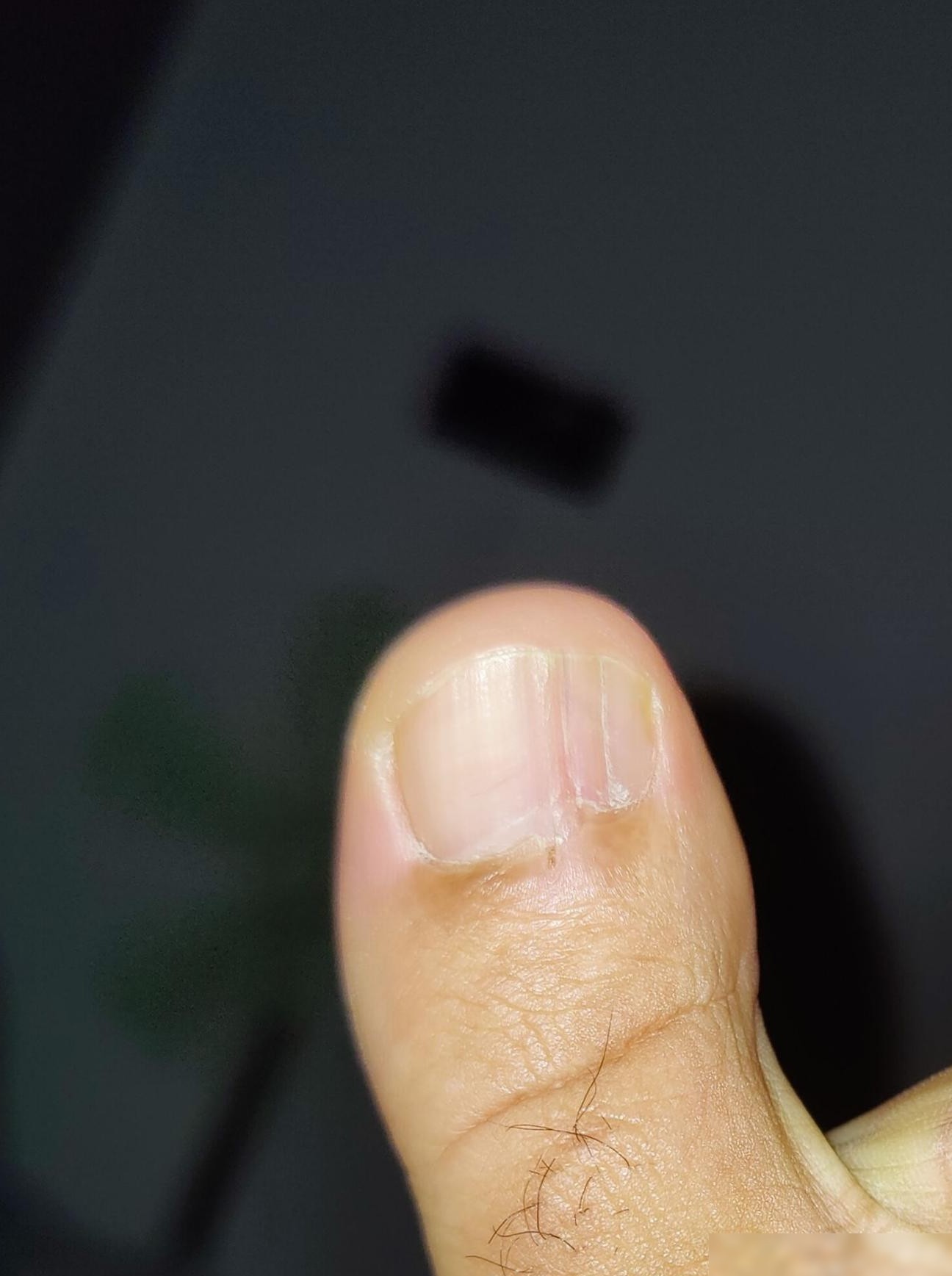 脚趾甲凸起开裂需警惕