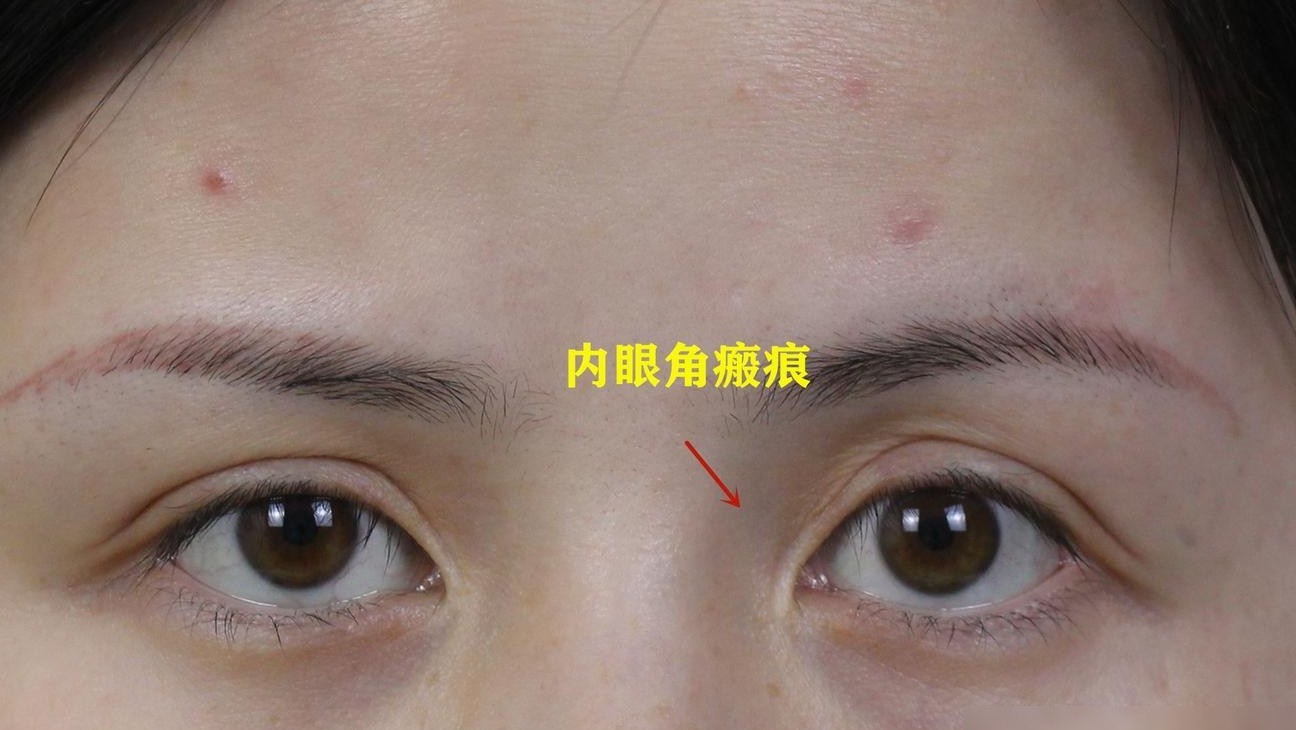 双眼皮修复可多次进行吗