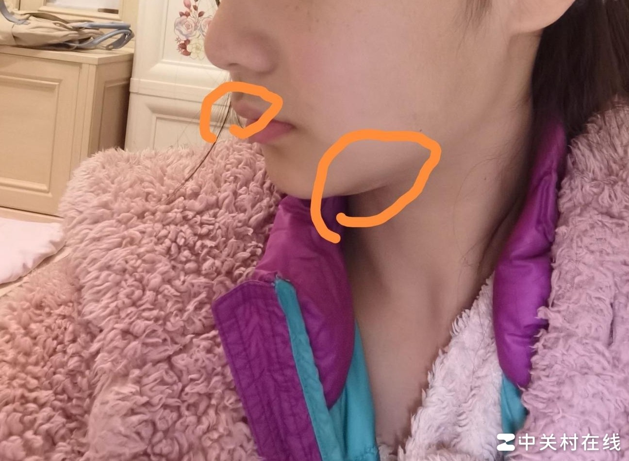 下巴赘肉与嘴凸改善方法