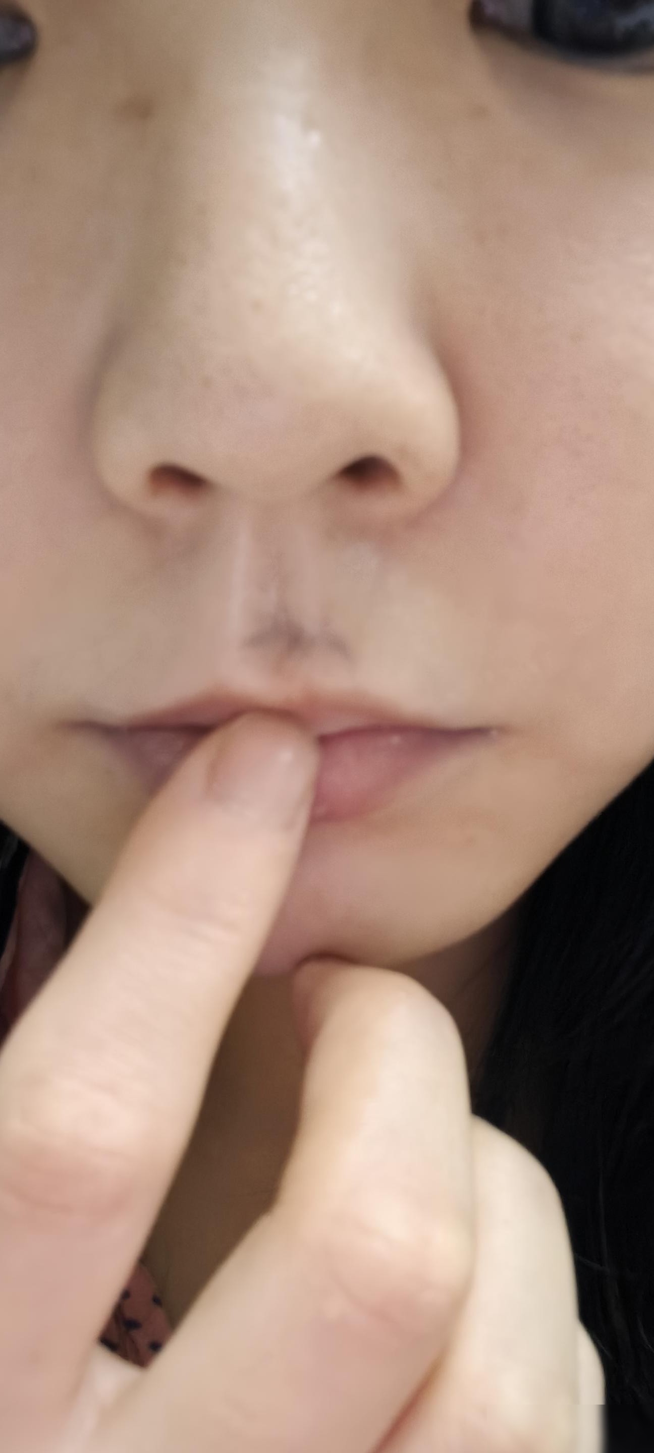 疤痕能去除吗？