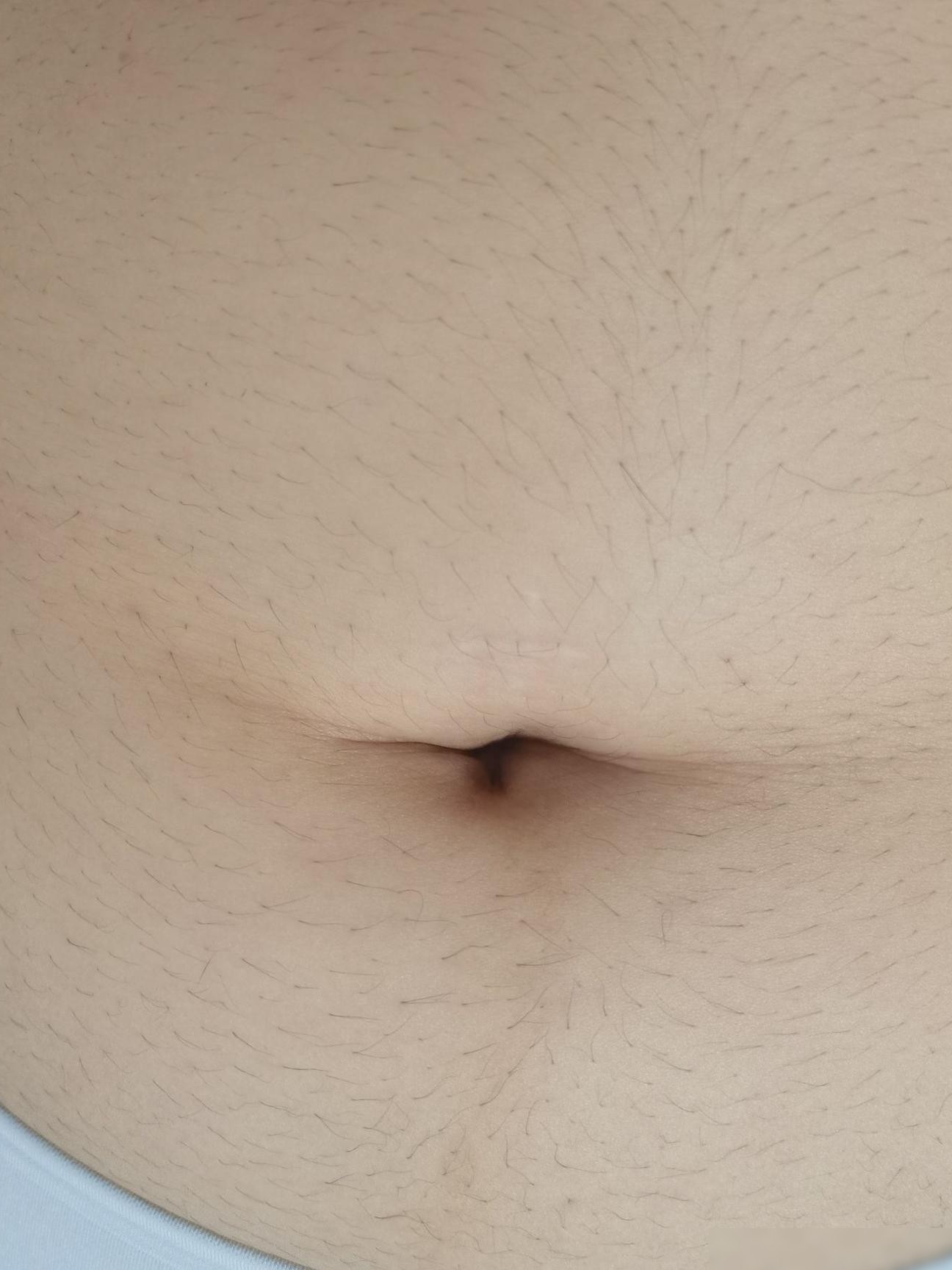女生体毛旺盛怎么办？