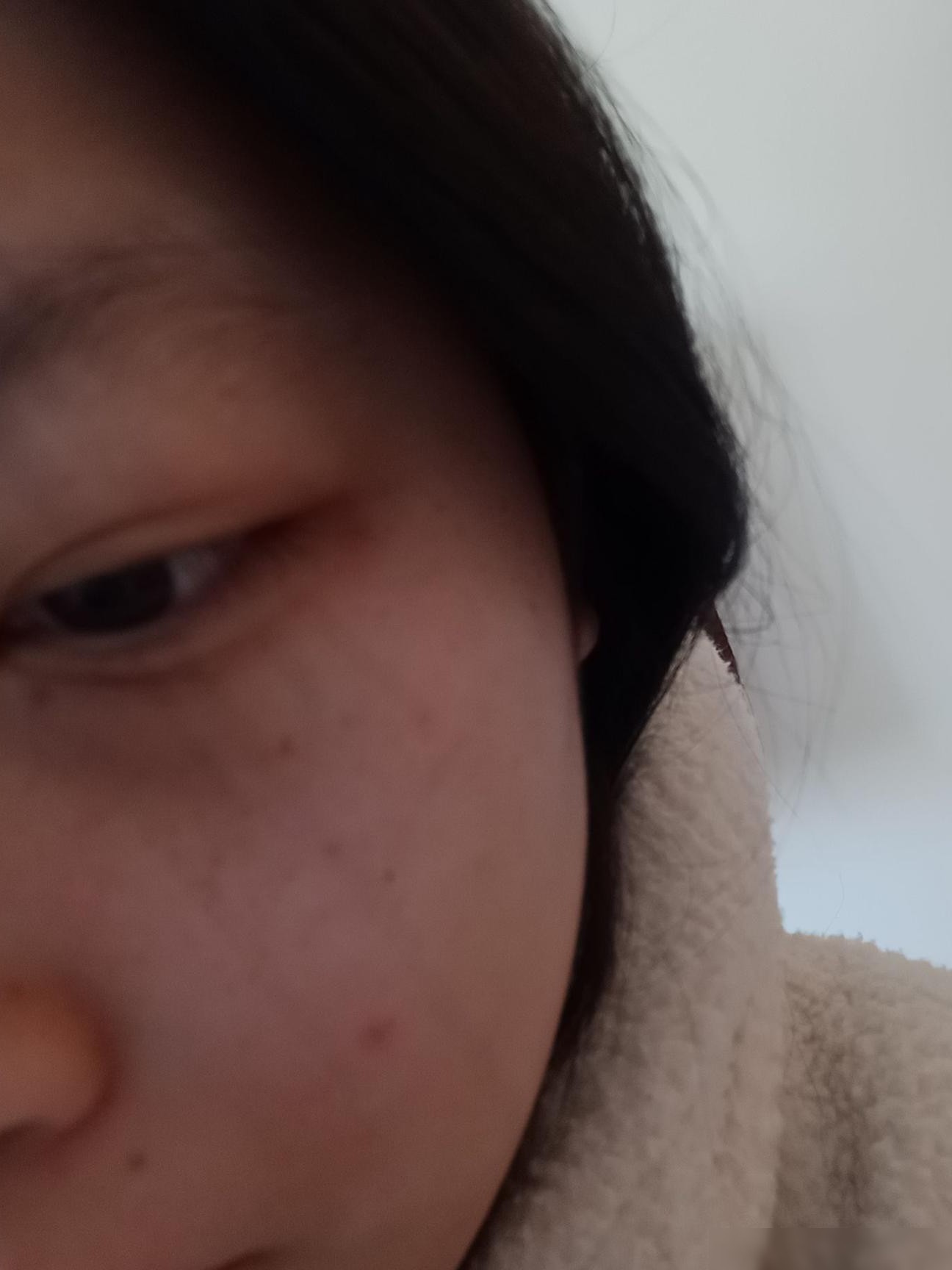 眼下的斑是什么？如何去除