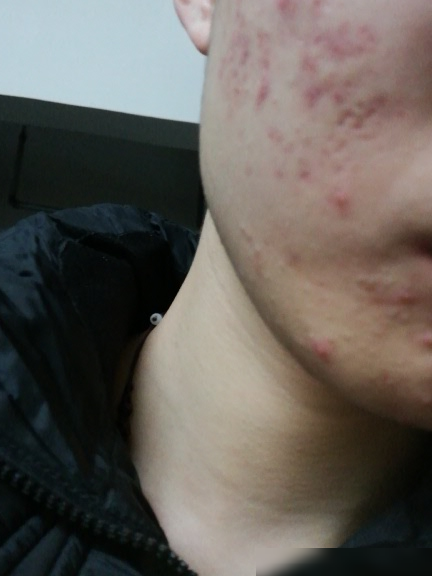 痘痘和痘印快速消除法