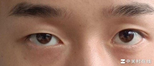 睡够仍有泪沟黑眼圈？