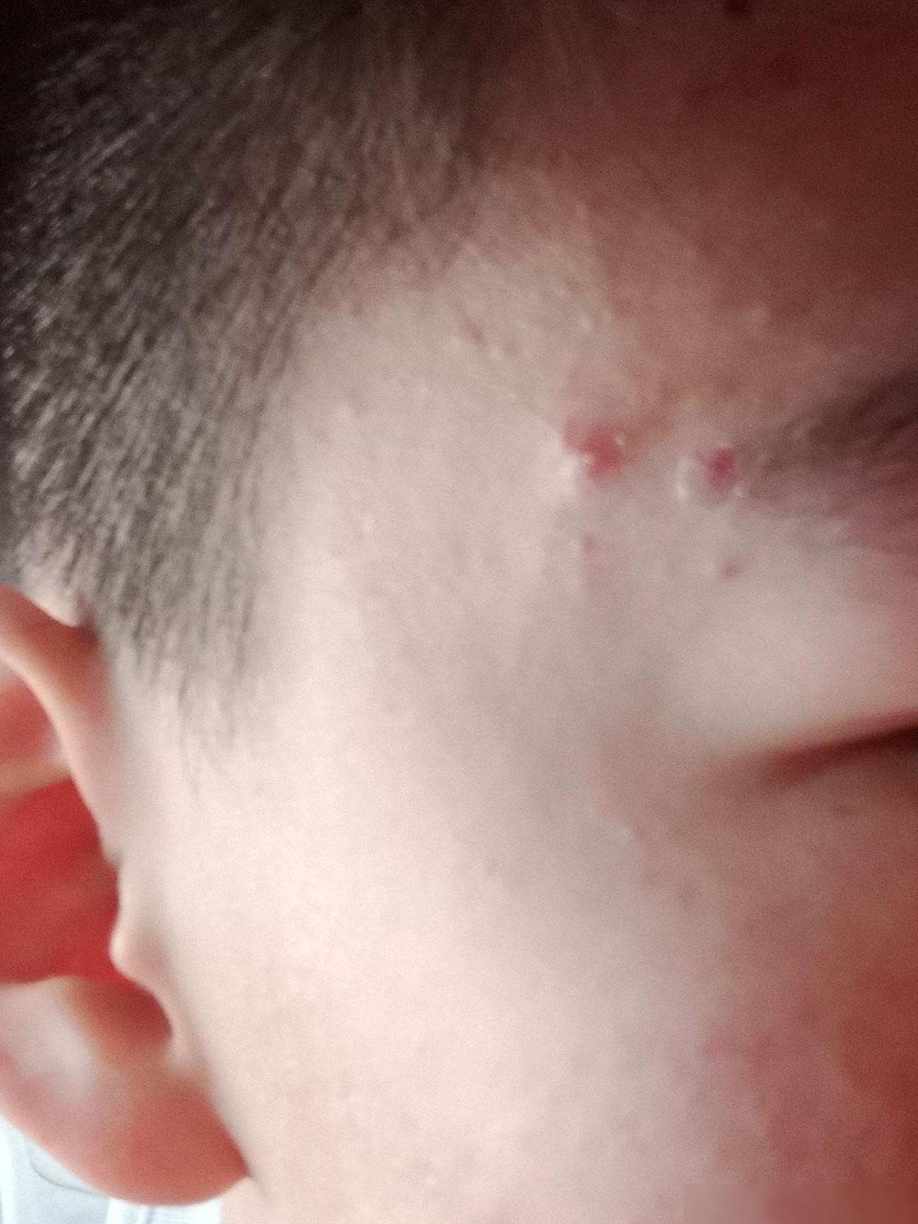 痘痘快滚蛋！实用祛痘法
