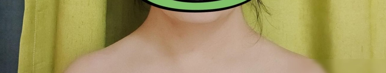 脖子粗怎么快速消？