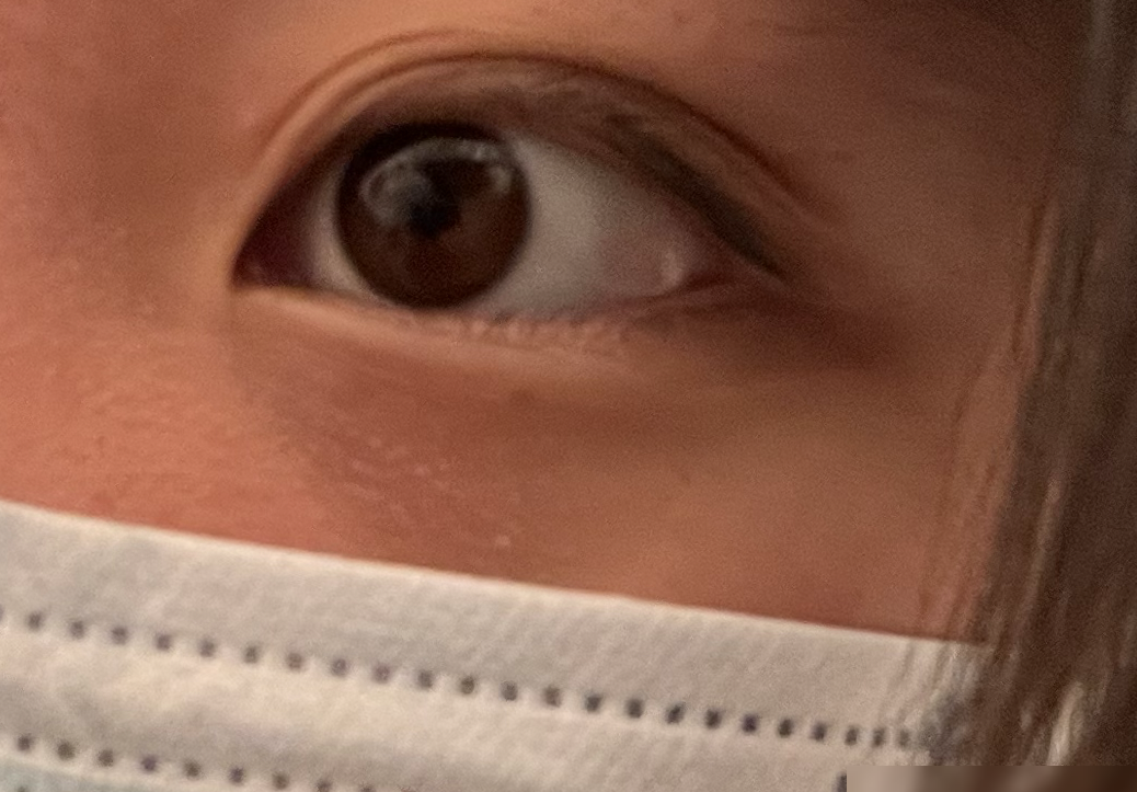 眼皮多出褶子怎么办