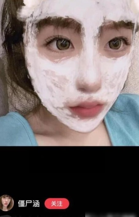 双眼皮修复成功案例