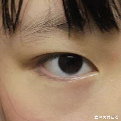 双眼不对称，能改善吗？