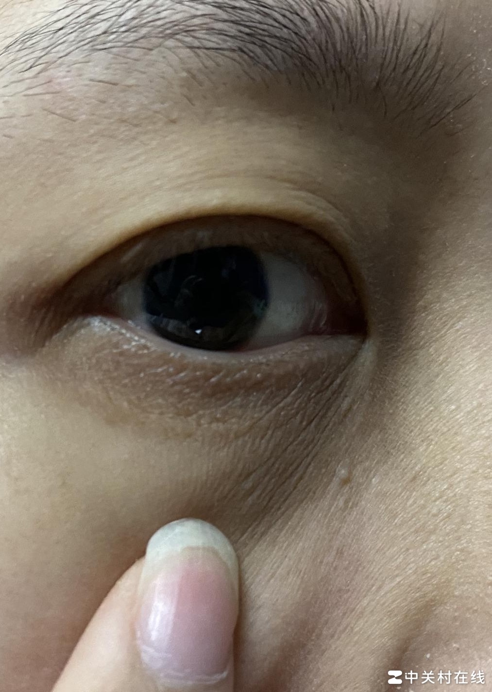 27岁干眼纹黑眼圈急救