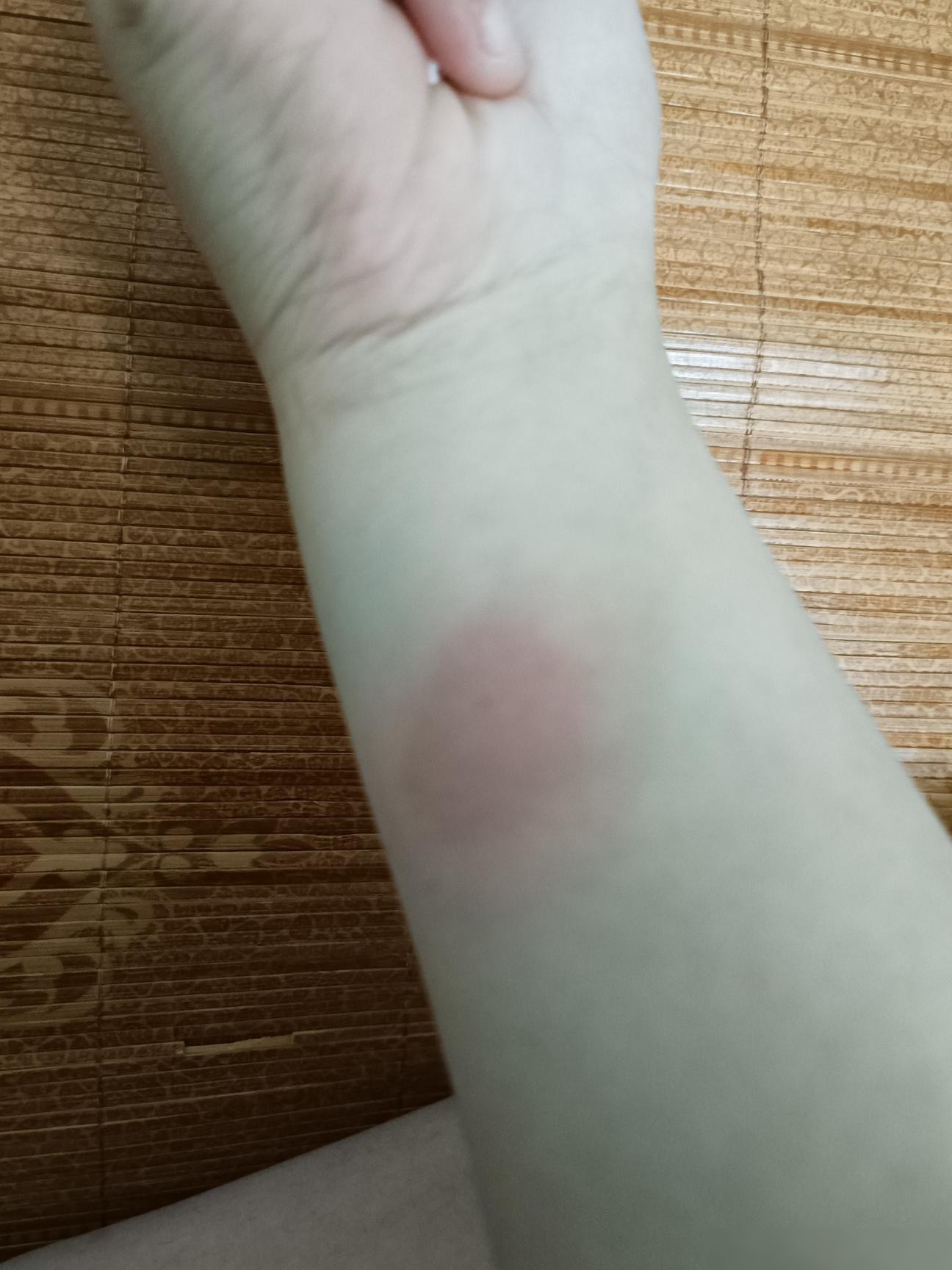 肺结核皮试结果正常吗