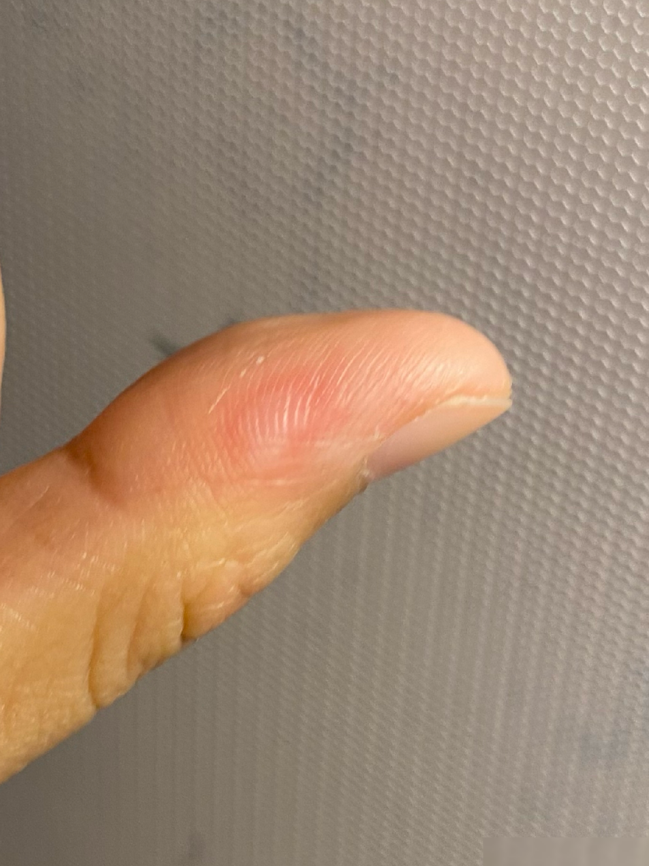 HPV感染了吗？