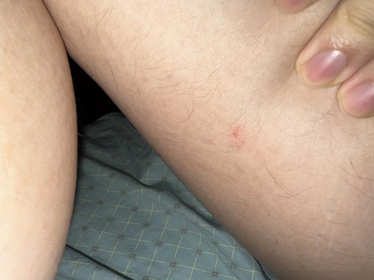 按摩时内裤滑落致皮炎？