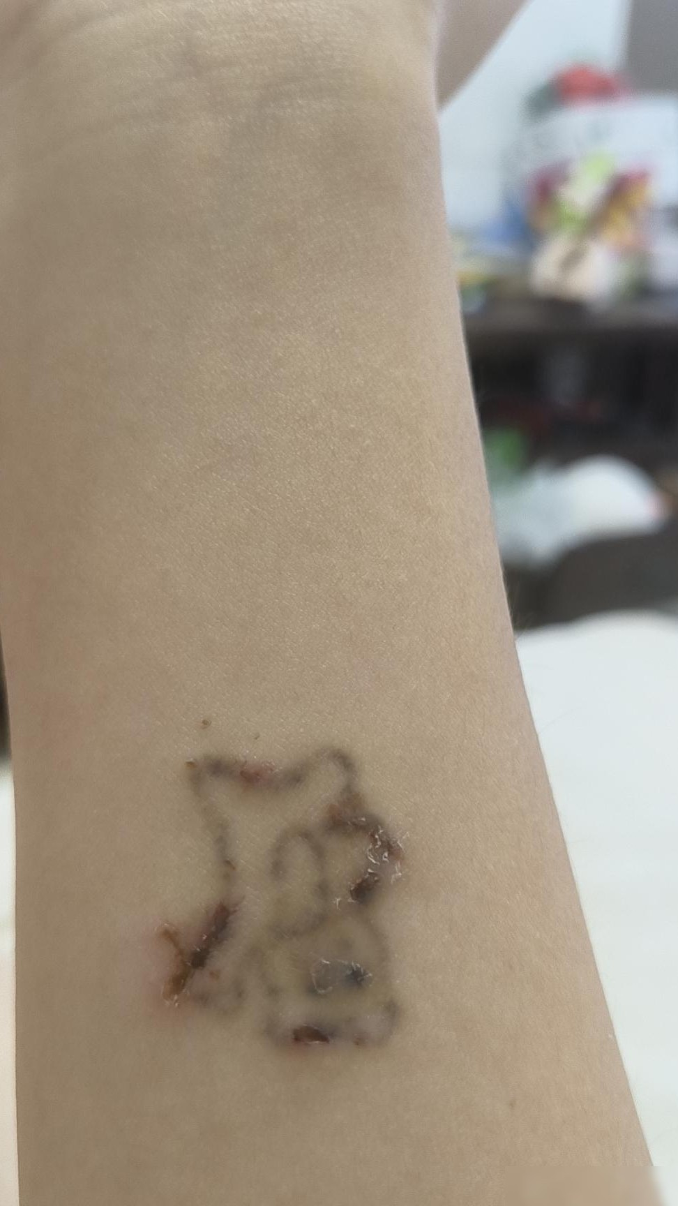 纹身能彻底洗掉吗？