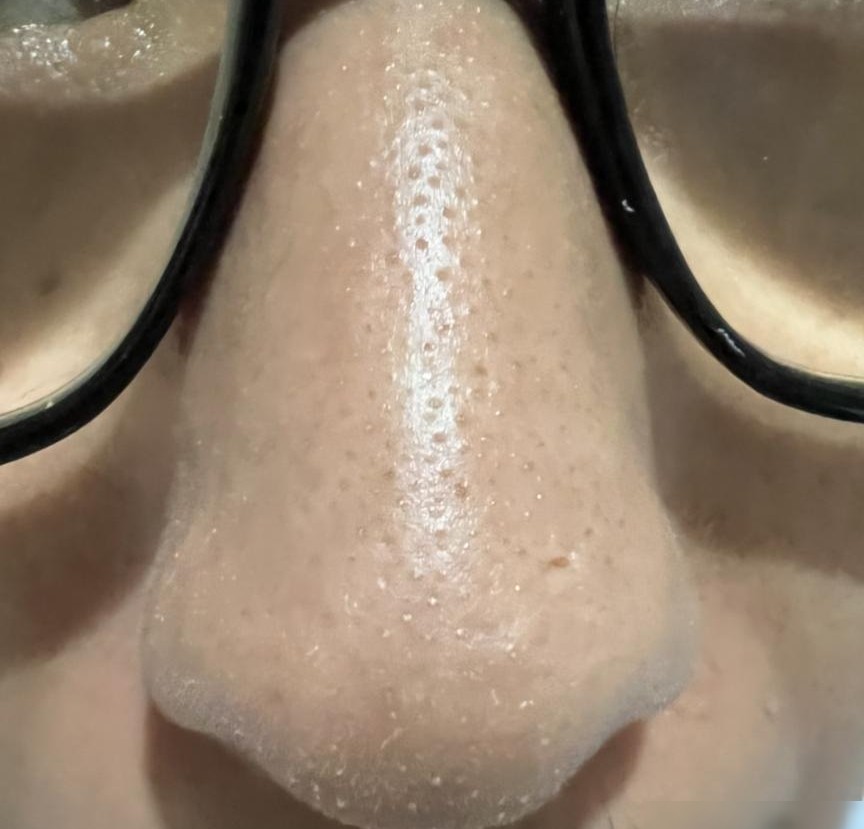 毛孔粗大黑头粉刺怎么办