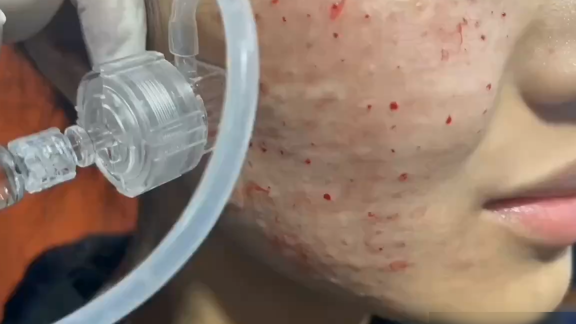 水光针注射方法详解